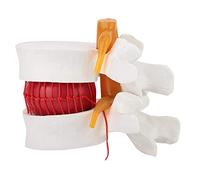 Josenidny 1: 1.5 Modelo de Demostración de Hernia Discal Del Modelo Lumbar para Anatomía
