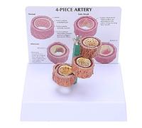 Josenidny La Aterosclerosis Trombosis Modelo Demostración De Enfermedades Gefeesser Modelo Gefeess Patología