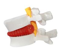 Joygoodta Material didáctico para aliviar la Hernia de Disco, Modelo de Cuerpo Humano de vértebra Lumbar Hernia de Disco, Modelo de Columna Lumbar de tamaño Natural 1, 5 Veces para enseñar y Aprender