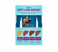 KCDFDVJFBM Fatty Liver Disease Educational Chart - Anatomy Health Reference Poster for Doctor Office, Clinic & School Wall Decor(Unframed,12x18inch(30x45cm))