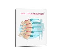 KCDFDVJFBM Poster of Degenerative Disc Disease 3 Stages Anatomy Educational Wall Chart Spine Health Diagram Doctor Office Decor Art(Unframed,08X12inch(20X30cm))