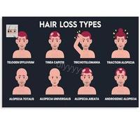 KCDFDVJFBM Salon Decor Educational Canvas Wall-Art Hair Loss Types and Patterns Chart Hair Health Science for Bedroom Decor(Unframed,12x18inch(30x45cm))