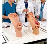 Kit De Modelo De Patología De La Úlcera Del Pie Diabético, Con Lesiones Purulentas De Grado Leve (niveles 1-3) Y Grave (niveles 4-5); Simulador De Pie Diabético Dos Etapas, Para Demostraciones Sobre