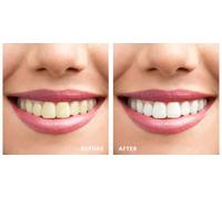 Kit Para Blanqueamiento De Dientes WhiteLight Con Luz LED Y Pasta Dental