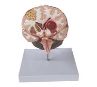 Kznifmk Modelo de Enfermedad del Cerebro Humano - Patología Cerebral Hemorragia del Encefálico Modelo de Enseñanza Médica - Modelo de Anatomía del Cerebro Humano