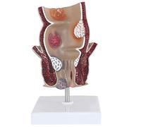 LBYLYH Modelo anatómico 5X La Enfermedad patológica del Modelo anatómico del Canal Anal y el Ancus de una Enfermedad anorecal Rectal.