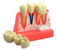 Lipfer Modelo De Implante Dental: Análisis Removible 4 Veces Demostración De Puente De Modelo De Dientes Análisis De Implante Dental Modelo De Diente para Aprendizaje Y Educación