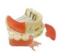 LKYLVEE Modelo De Dientes De Restauración Tipodonta De Implantes Dentales - Modelo De Implante De Dientes Transparentes - para La Herramienta del Modelo De Educación Y Estudio,E,7cm