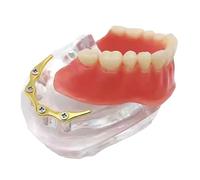 LKYLVEE Modelo De Dientes De Restauración Tipodonta De Implantes Dentales - Modelo De Implante De Dientes Transparentes - para La Herramienta del Modelo De Educación Y Estudio,F,7cm