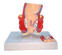 LKYLVEE Modelo de Patología de Acné Anorrectal - Modelo de Enseñanza Médica Modelo de Patología de Hemorroides - Modelo Anatómico Intestinal Rectal,B,14CM