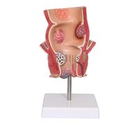 LKYLVEE Modelo de Patología de Acné Anorrectal - Modelo de Enseñanza Médica Modelo de Patología de Hemorroides - Modelo Anatómico Intestinal Rectal,A,14CM