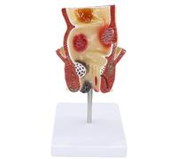 LKYLVEE Modelo Patológico Rectal - Modelo de Lesión Hemorroidal Rectal - Modelo de Patología de Hemorroides para Enseñanza Médica, Estudio y Exhibición,Flesh,22cm