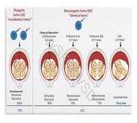LLBOGRGGN Twin Pregnancy Placentation Process Educational Canvas Wall-Art Human Anatomy Science Chart for Midwife Nurse Office Decor(Framed,08x12inch(20x30cm))