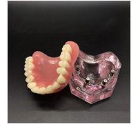 LUCKFY Modelo Dental - Dientes Transparente Implante Modelo - Dientes sobredentadura Superior 4 implantes de demostración para la enseñanza y estudiar