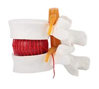 lvifloae Modelo de Columna Lumbar 1:1.5, Modelo de Hernia de Disco Lumbar Humano, Herramienta de Aprendizaje de anatomía Realista, Modelo de Disco elástico Suave para enseñanza