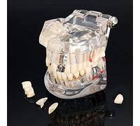 Lxwyq Modelo transparente de los dientes de la enfermedad, modelo transparente de los dientes del implante dental del dentista de la enfermedad estándar del diente extraíble modelo de enseñanza