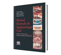 MANUAL ILUSTRADO DE IMPLANTOLOGIA ORAL *** ED. AMOLCA ***