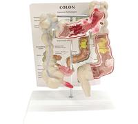 MASKIS Modelo De Patología Humana del Intestino Grueso, Modelo Anatómico del Intestino Grueso Humano Modelo De Lesión Visceral, Modelo De Patología del Colon, PVC Anatomía Anatómica Humana Sistema