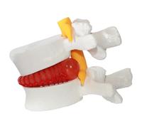 Material didáctico para aliviar la hernia de disco, modelo de cuerpo humano de PVC de vértebra lumbar herniada, modelo de columna lumbar de tamaño natural 1, 5 veces para enseñar, aprender y demo