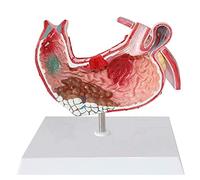 MFRELMNZG Modelo de anatomía de órganos Humanos Modelo de anatomía anatómica - Estómago Humano - Modelo de Gastritis Modelo de lesión gástrica