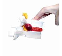 mike-dental Hernia Hernia de Disco Lumbar lumbar modelo anatómico, humano médica anatomía