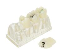Mikikit Modelo de Diente Caries Oral para Demostración Clínica Textura Realista y Material Abs Adecuado para Comunicación Pacientes y Enseñanza Dental