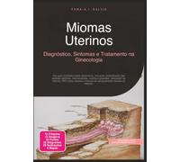 Miomas Uterinos: Diagnóstico, Sintomas e Tratamento na Ginecologia