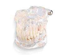 MLMLH Modelo de Dientes Desmontable Adultos, Modelo de Dientes de Implantes Dentales, Enfermedad Transparente Modelo de Dientes, Modelo de Patología de Enseñanza, para Oficinas Dentale