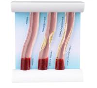 Modelo 3D de Vasos sanguíneos Humanos con características patológicas, comparación de obstrucciones, Molde de visualización de Placas lipídicas para educación e investigación médica