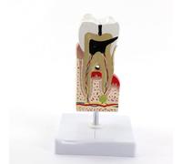 Modelo agrandado for el cuidado de los dientes humanos, caries dental, caries dental, suministros médicos for estudiantes de medicina, recursos didácticos, modelo anatómico