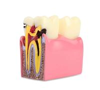 Modelo Ampliado De Caries Dental - Anatomía Dental 6/8x para Educación Dental, Exhibición De Patología Y Material Didáctico Estudiantes Y Profesionales.