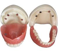 Modelo anatómico de dentadura postiza desmontable, sobredentadura de boca completa con estructura de implante dental, modelo de demostración de enseñanza for escuela de odontología for