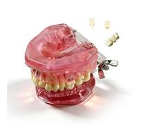 Modelo anatómico de dientes removibles, modelo de implante fantoma dental, modelos de tipodonto dental con 28 dientes desmontables para estudio y enseñanza(pink)