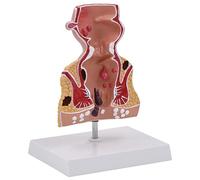 Modelo Anatómico De Enfermedades Intestinales, Modelo De Patología Rectal Humana con Base Antideslizante, Aumento De 1,5 Veces Y Diseño De Simulación Realista, Diseño Desmontable, para Clínicas