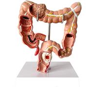 Modelo anatómico de intestino Grueso Humano Modelo de patología del Colon - Modelo de lesión visceral de PVC Anatómica Anatomía Humana Sistema digestivo Estudiando Modelo de enseñanza