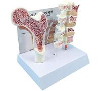 Modelo Anatómico De La Columna Vertebral Humana, Femoral Osteoporosis Fémur Anatómica Vertebral Modelo Modelo De La Anatomía De La Columna Lumbar