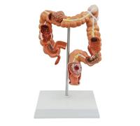 Modelo anatómico de lesión colon humano con base detallada patología gastroenterológica del intestino grueso for la enseñanza médica