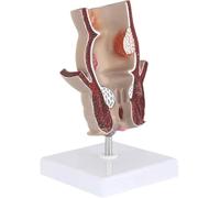 Modelo anatómico de lesión hemorroidal rectal humana, modelo anatómico de fístula hemorroidal anal 5X, modelo rectal patológico humano, enseñanza médica de ano y hemorroides, aprendizaje