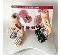 Modelo anatómico de patología normal pulmonar, modelo comparación pulmón sano y patológico, aula for educación médico paciente