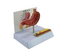 Modelo anatómico de perforación gástrica, modelo de anatomía estomacal patológica para entornos clínicos, lecciones de enseñanza, informe, herramienta de entrenamiento