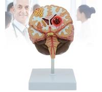 Modelo Anatómico Del Cerebro Humano, Modelo Patológico de Malformación Arteriovenosa Cerebral de Hemorragia Cerebral, Aprendizaje en El Aula de Ciencias de Enseñanza Médica