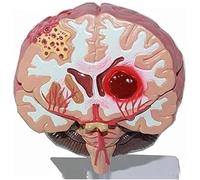 Modelo anatómico del cerebro, modelo de accidente cerebrovascular Hemorragia cerebral Malformación arteriovenosa cerebral Patología cerebral Modelo de enseñanza de biología 1:1 Modelo de estructura ce