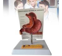 Modelo anatómico del estómago, modelo patológico humano de úlcera gástrica, modelo médico anatómico patológico del estómago para el aprendizaje, la exposición y la enseñanza de la medicina.