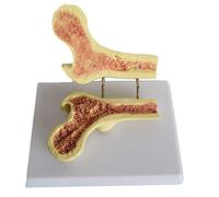 Modelo Anatómico del Fémur - Modelo De Comparación Entre El Modelo Femoral Normal Y El Modelo Femoral Enfermo - para Equipos De Enseñanza De Intercambio Médico