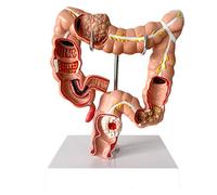 Modelo anatómico del intestino Grueso Humano Modelo de patología del Colon - Modelo de lesión visceral de PVC Anatomía anatómica Humana Sistema digestivo Estudio Modelo de enseñanza