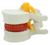 Modelo anatómico humano de hernia discal lumbar, modelo didáctico de vértebra lumbar, modelo de músculo humano for estudios de ciencias médicas.