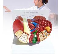 Modelo anatómico humano del hígado, con características de cirrosis hepática, textura clara y patología, para el estudio y la investigación en el ámbito escolar.