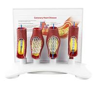 modelo anatómico, Modelo anatómico de obstrucción vasos sanguíneos del corazón y el cerebro humanos - stent en cuerpo humano for fines didácticos