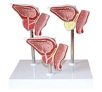 Modelo anatómico, Modelo anatómico del sistema urinario humano, modelo de enfermedad la glándula fisura anterior, tres partes for herramienta presentación escolar
