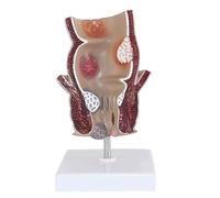 Modelo anatómico patológico de hemorroides rectales. Órgano colorrectal detallado que muestra, fístulas, fisuras y abscesos